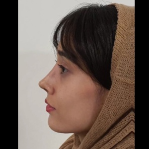 rhinoplasty50
