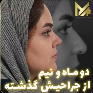 rhinoplasty52