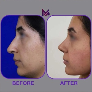 rhinoplasty54