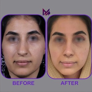rhinoplasty55