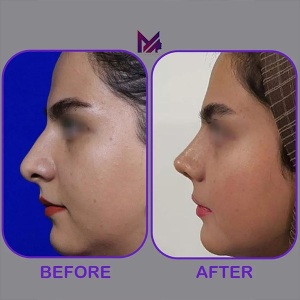 rhinoplasty57
