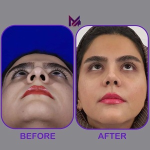 rhinoplasty58