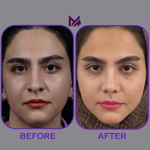 rhinoplasty59