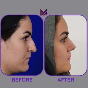 rhinoplasty60