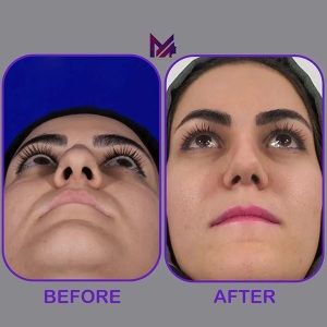 rhinoplasty61