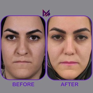 rhinoplasty62