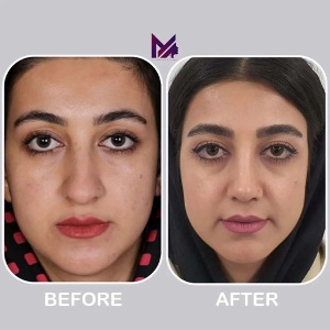 rhinoplasty63