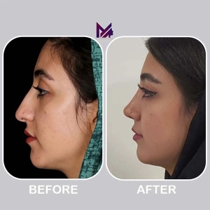 rhinoplasty64