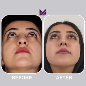 rhinoplasty65