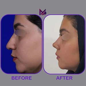 rhinoplasty66
