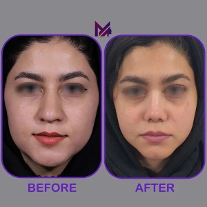 rhinoplasty67