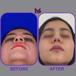 rhinplasty68