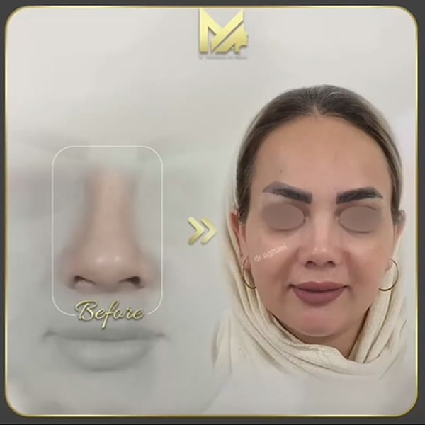 جراحی بینی کج + دکتر محمدعلی آقایی