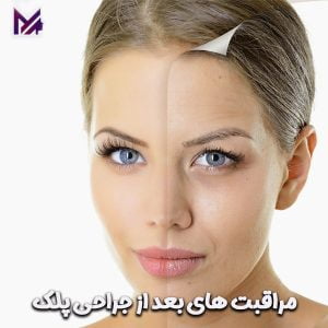مراقبت های بعد از جراحی پلک
