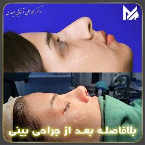 جراحی بینی فانتزی-دکتر محمد علی آقایی