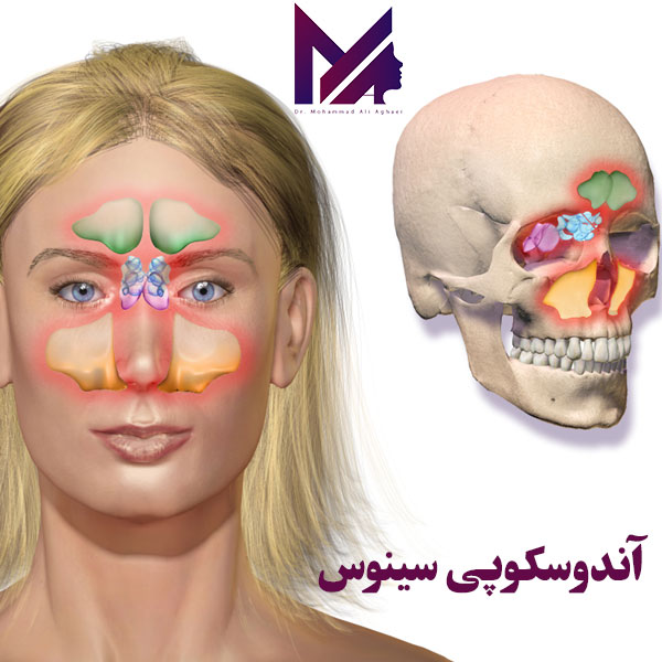 آندوسکوپی سینوس - دکتر محمدعلی آقایی https://dr-aghaee.com/