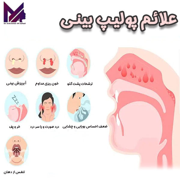 پولیپ بینی _ دکتر آقایی