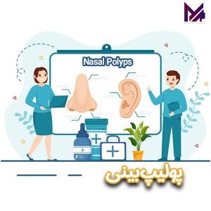 پولیپ بینی _ دکتر آقایی