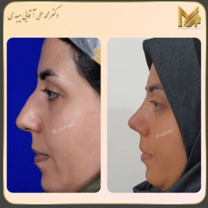 جراحی بینی نیمه فانتزی - دکتر محمدعلی آقایی 