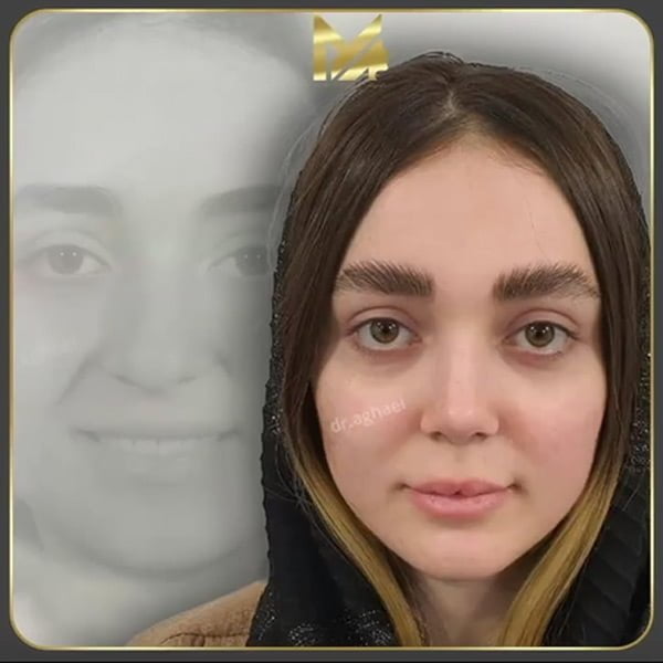 جراحی بینی در یزد + دکتر محمدعلی آقایی