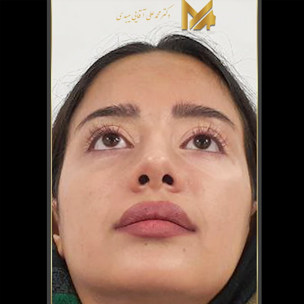 جراحی بینی فانتزی نمونه کار 
