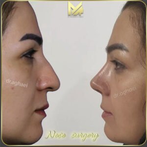 نمونه جراحی بینی فانتزی 