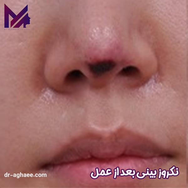 نکروز بینی بعد از عمل - دکتر محمد علی آقایی