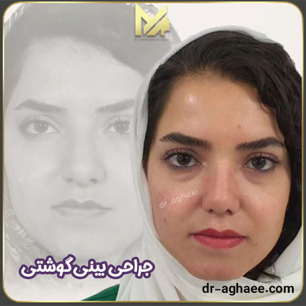 جراحی بینی گوشتی - دکتر محمد علی آقایی 