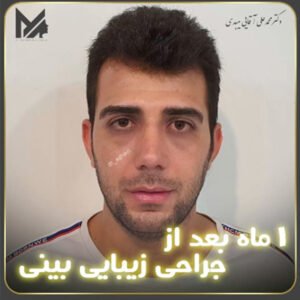 جراحی بینی استخوانی 2 - دکتر محمد علی آقایی