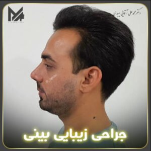 جراحی بینی استخوانی - دکتر محمد علی آقایی