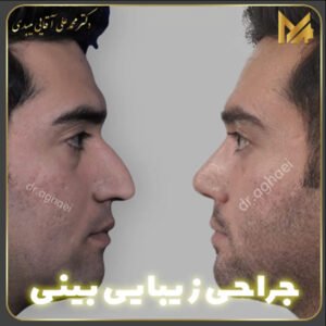 جراحی بینی استخوانی - دکتر محمد علی آقایی