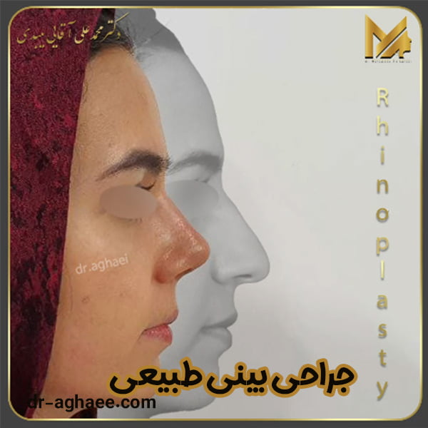 جراحی بینی طبیعی - دکتر محمد علی آقایی