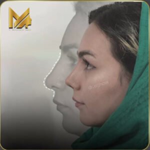 نمونه عمل بینی در یزد 2