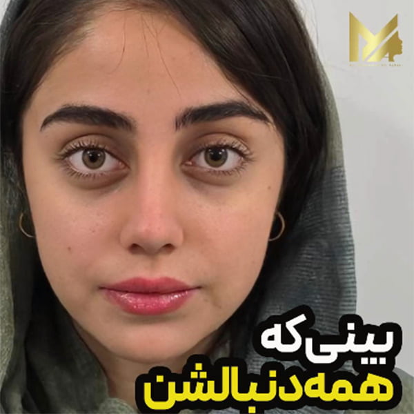 نمونه عمل بینی توسط دکتر آقایی جراح بینی خوب یزد