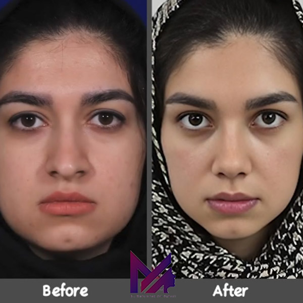 جراحی بینی گوشتی https://dr-aghaee.com/