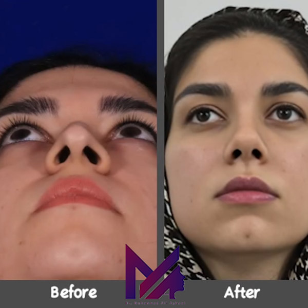 جراحی بینی گوشتی https://dr-aghaee.com/