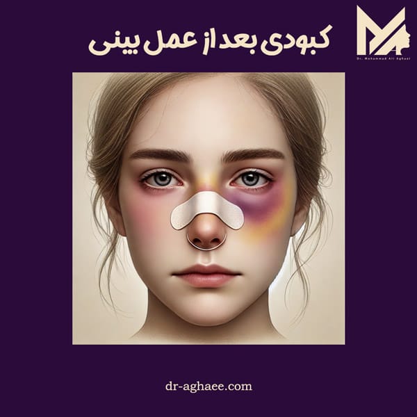 کبودی بعد از عمل بینی https://dr-aghaee.com/