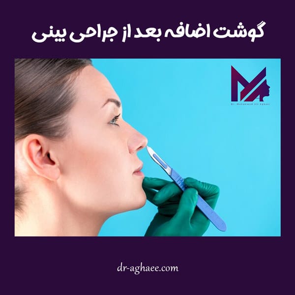 گوشت اضافه بعد از جراحی بینی https://dr-aghaee.com/