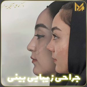 نمونه جراحی بینی در یزد 2