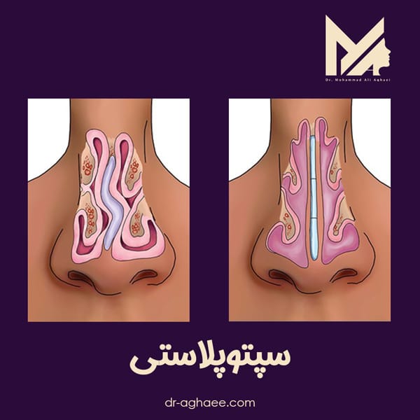 سپتوپلاستی https://dr-aghaee.com/
