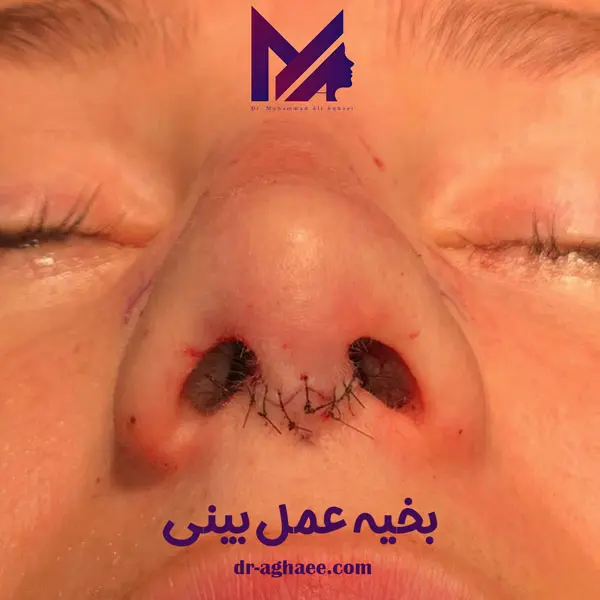 بخیه عمل بینی