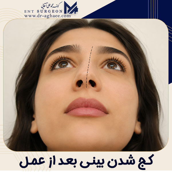 کج شدن بینی بعد از عمل + دکتر محمدعلی آقایی