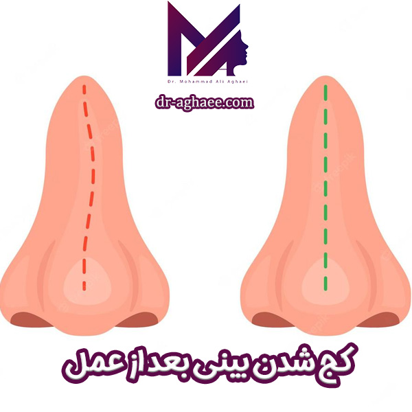 کج شدن بینی بعد از عمل