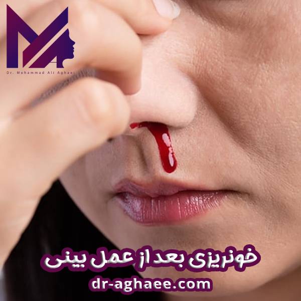 خونریزی بعد از عمل بینی