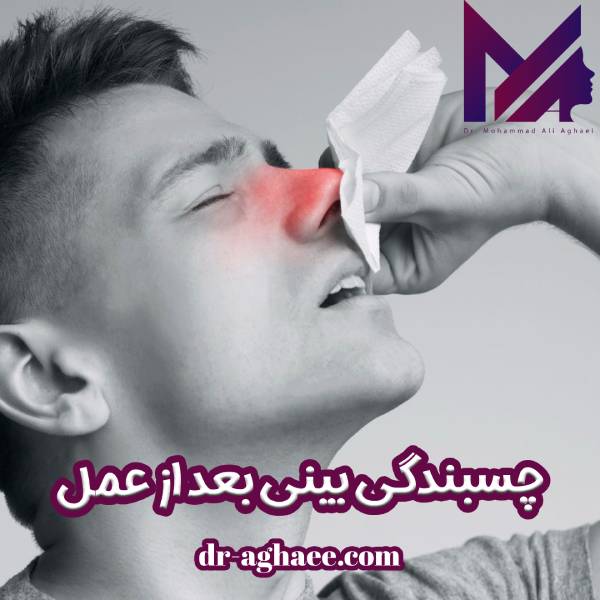 چسبندگی بینی بعد از عمل