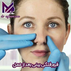 فرورفتگی بینی بعد از عمل