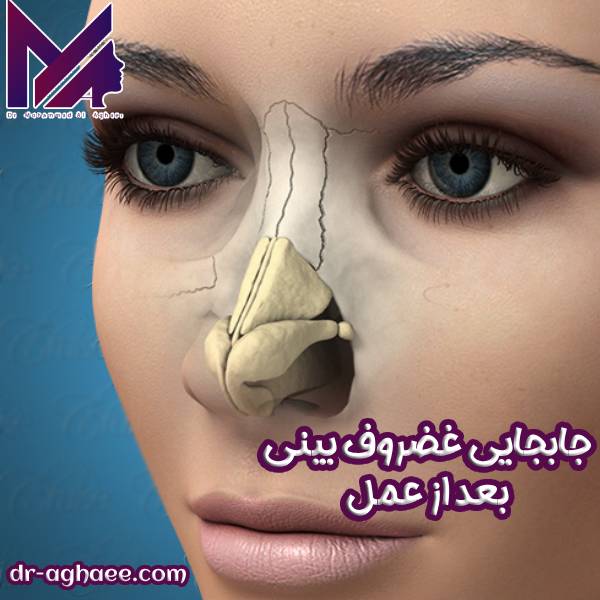 جابجایی غضروف بینی بعد از عمل