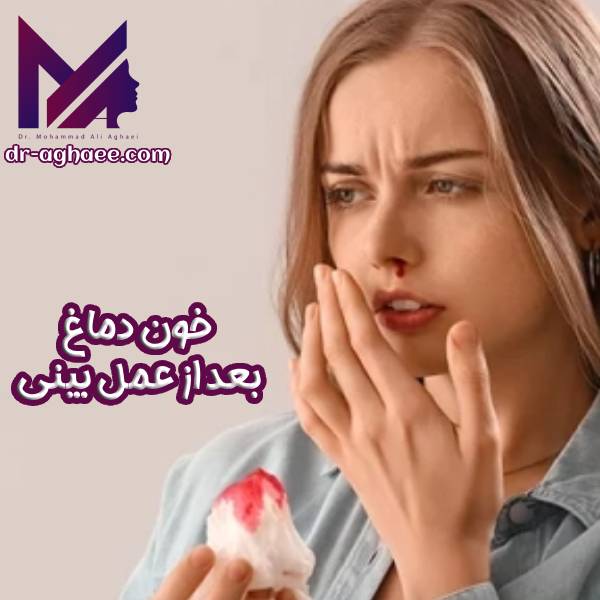 خون دماغ بعد از عمل بینی