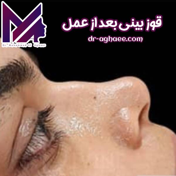 قوز بینی بعد از عمل