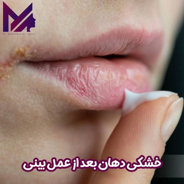 خشکی دهان بعد از عمل بینی